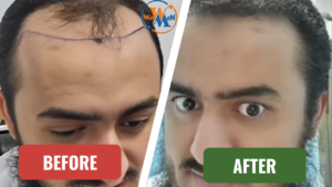 Before and After Image Wowmen