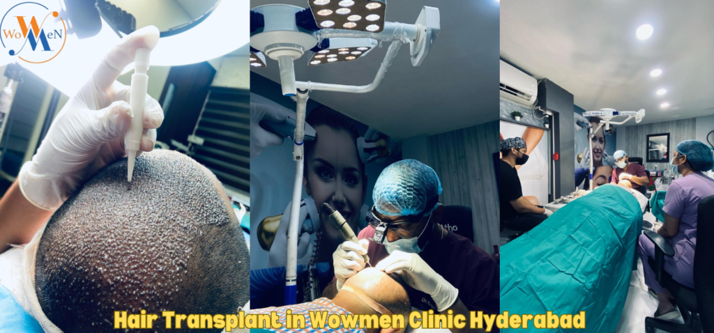 Hair Transplants in Wowmen Clinic Hyderabad