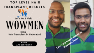 Top level hair transplant results