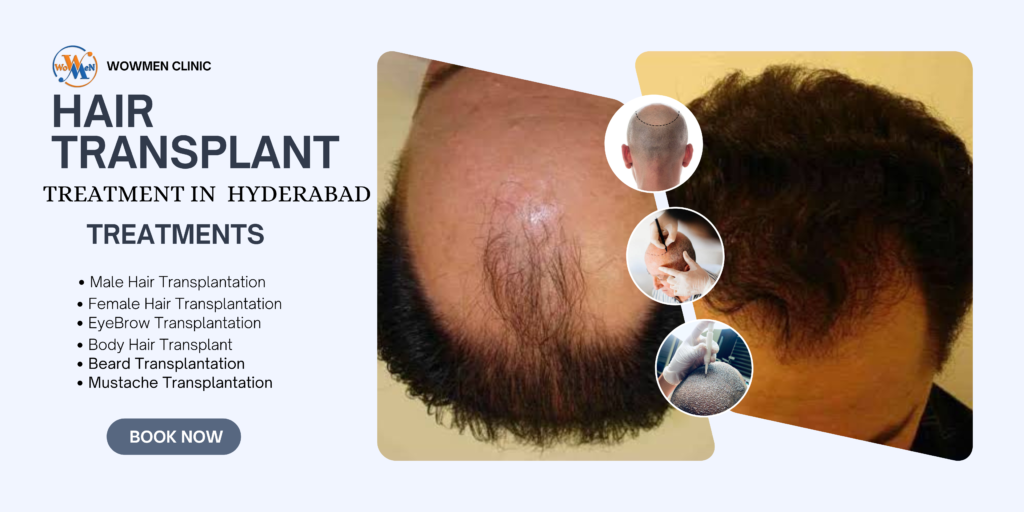 Common Myths About Wowmen Hair Transplant Clinic in Hyderabad – Busted by Dr. Srikanth Yadav Puligilla’s Hair Transplant Centre