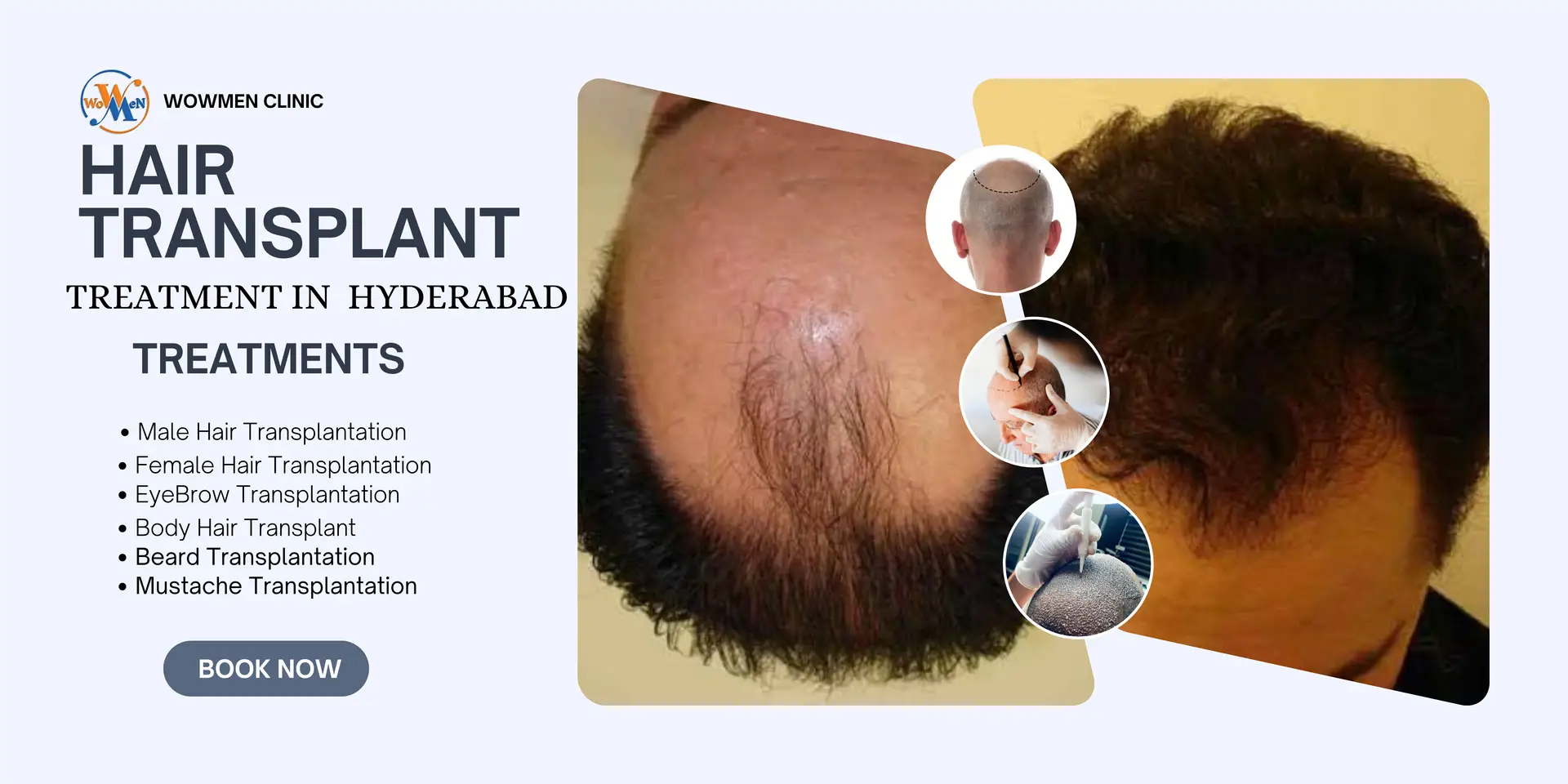 Hair Transplant Clinic