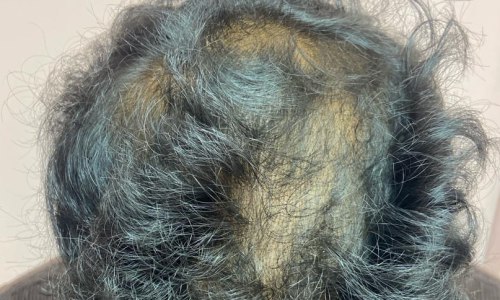 hair-loss-transp